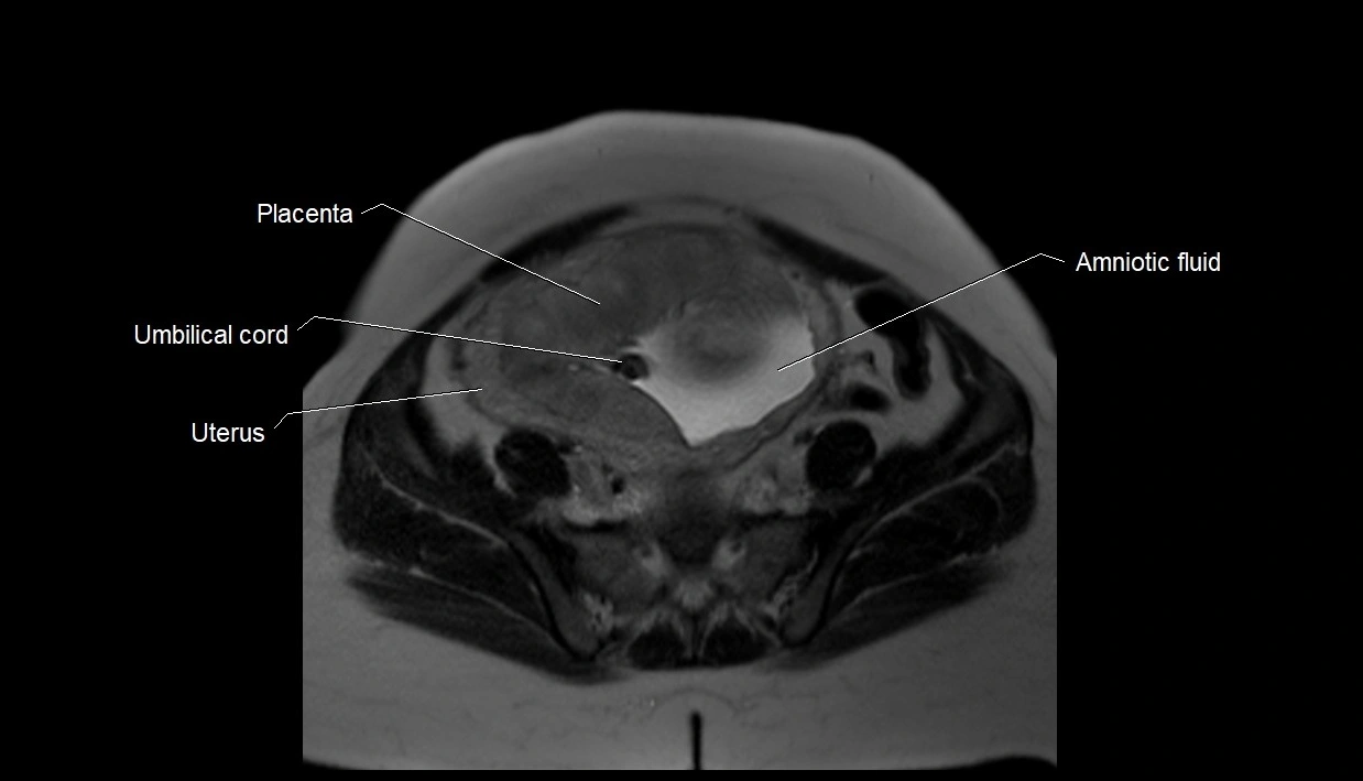 MRI fetal anatomy axial image 28.webp